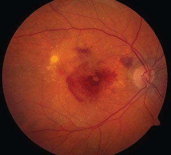 AMD disease activity can be monitored through 3D retinal OCT scans that highlight affected areas. Image courtesy of National Eye Institute/NIH.