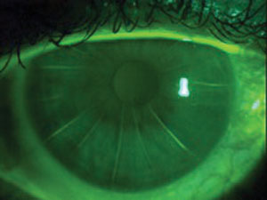 Patients who underwent refractive surgery in its earliest form—radial keratotomy—need not always be denied premium IOLs, study finds. Image courtesy of Robert Ensley, OD, and Heidi Miller, OD. 