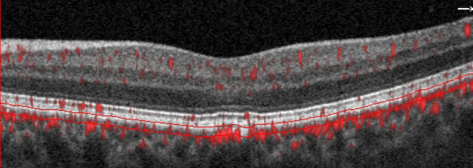 OCT-A imaging is revealing more about choriocapillaris function and its earliest presentations of disease. Shown here is a glaucoma suspect with no visible abnormality on fundus exam. However, B-scan with segmentation lines set at the choriocapillaris depict a non-exudative occult choroidal neovascular membrane. Image courtesy of Julie Rodman, OD. 