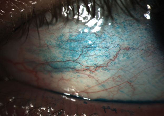 Patients with gout are more likely to develop dry eye symptoms. Image courtesy of Whitney Hauser, OD.
