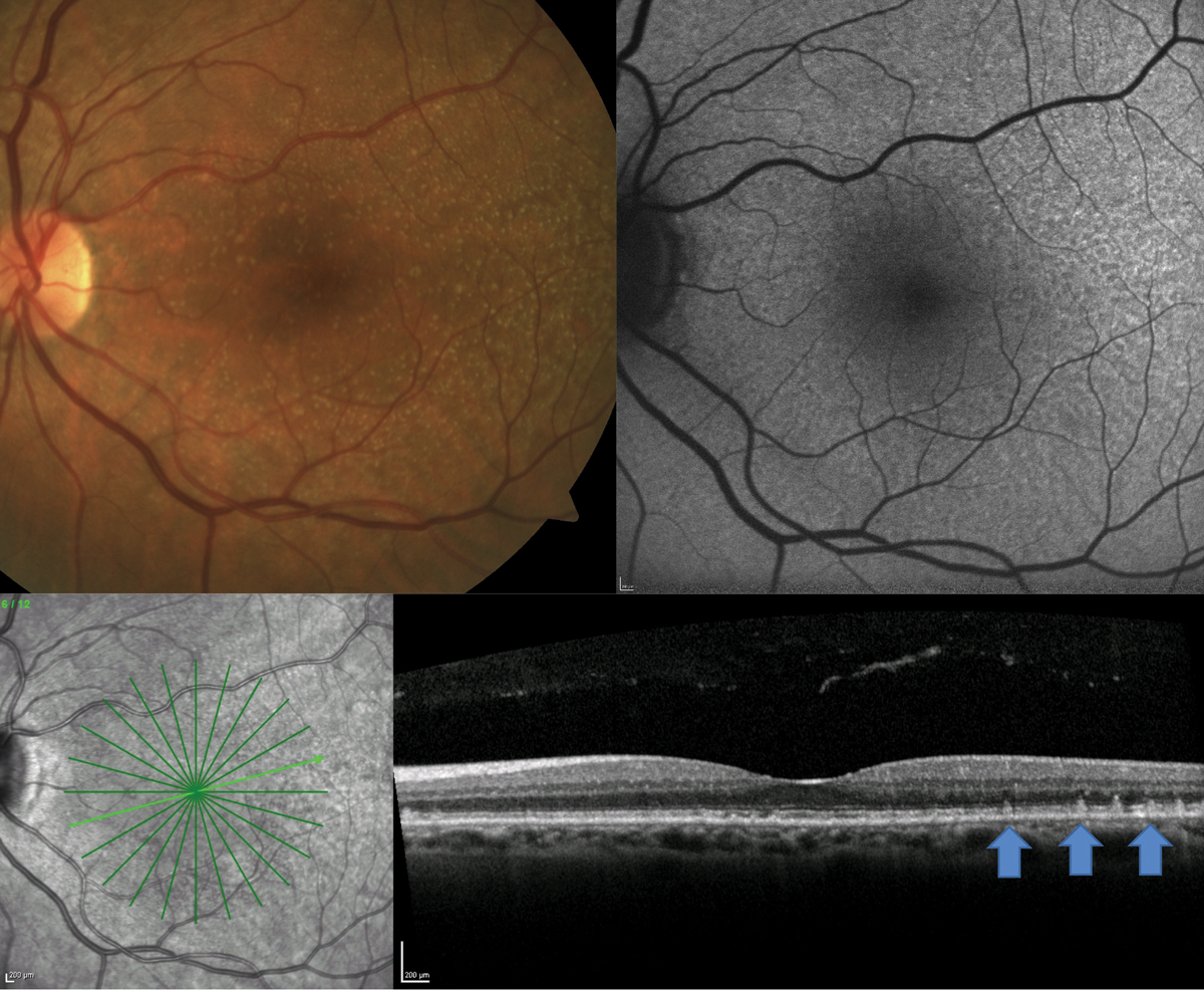 Fig. 3. A patient with clinically visible small- to medium-sized drusen shows presence of RPD on FAF and OCT.