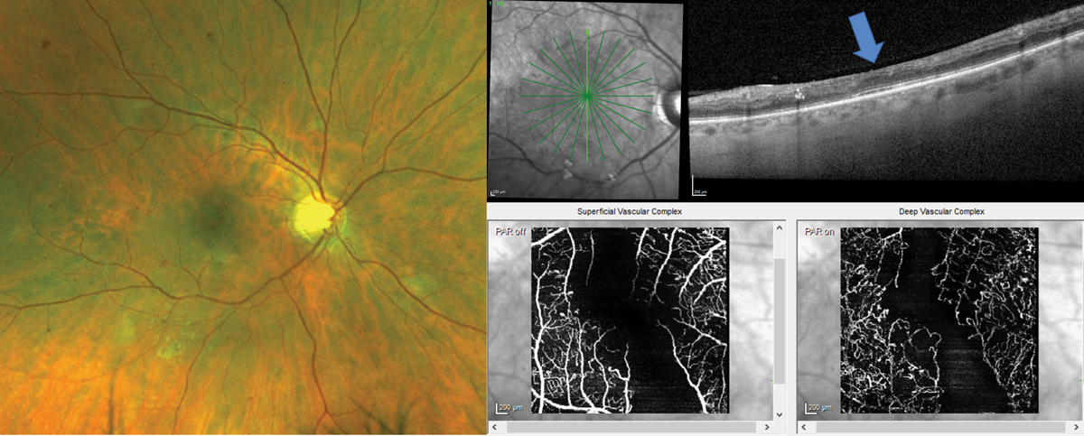 Fig. 4. Patient with clinically visible moderate nonproliferative DR with intraretinal hemorrhages, microaneurysms and cotton wool spots has diffuse inner retina thinning on the OCT cross-section scan (blue arrow shows position of the fovea). OCT-A confirms significant macular ischemia both in the superficial and deep capillary plexi that feed the inner retina.