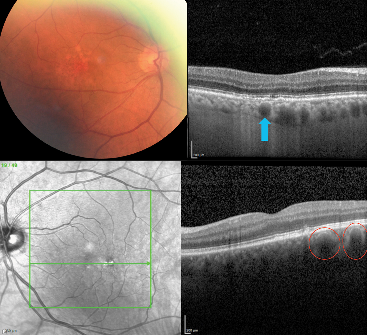 Fig. 6. A well-delineated pachyvessel (top; blue arrow) and several adjacent ones in a patient with RPE disruption mimicking AMD (bottom), a 72-year-old Caucasian on AREDS2 for AMD. Note the thickened choroid (which should be thinner in AMD) and two pachyvessels (red circles), one of which is just below the RPE disruption.