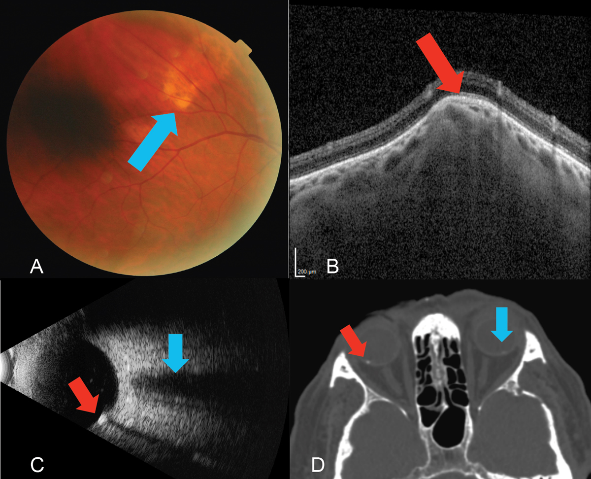Fig. 12. (A) Fundus photo of the yellow, subretinal lesion (blue arrow) located in the superior temporal quadrant of the right eye. (B) EDI-OCT (Spectralis, Heidelberg) through the SCC reveals a type 2 “rolling” lesion. Note the choroidal thinning above the lesion (red arrow). (C) B-scan ultrasound using the 10MHz probe highlights the echo-dense SCC (red arrow) with acoustic orbital shadowing which appears much smaller but similar to the optic nerve which is shown above this area (blue arrow). A choroidal melanoma would demonstrate low to medium internal echoes. (D) A previously ordered CT scan on a patient with SCC of the right eye (red arrow) and a subtle one in the left (blue arrow), which was not visible on clinical exam. Though not necessary in this case, sometimes radiological testing can be a form of multimodal imaging.