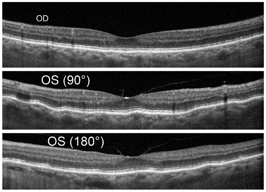 Fig. 13. Baseline OCT shows OD (top) mild disruption of the RPE however normal macular contour and choroidal  thickness. OS (middle and bottom) shows mild choroidal folds that are typically more visible in vertical scan line as seen here. Mild flattening of foveal pit by vitreomachular adhesion and traction and similar choroidal thickness as compared with OD. 