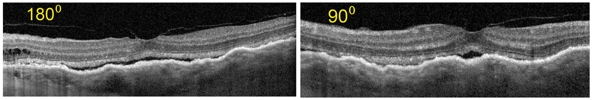 Fig. 17. OCT shows Increased choroidal thickness and folds as compared with the baseline OCT. Also, subretinal fluid as the result of serous RD is notable.