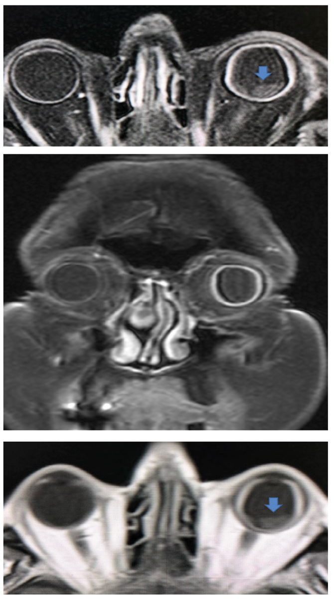 Fig. 18. Coronal (middle) and sagittal (top and bottom) with and without enhancement shows a difference in scleral thickness of the left vs the right eye. In the sagittal views, the presence of detached areas can be seen (blue arrow). 