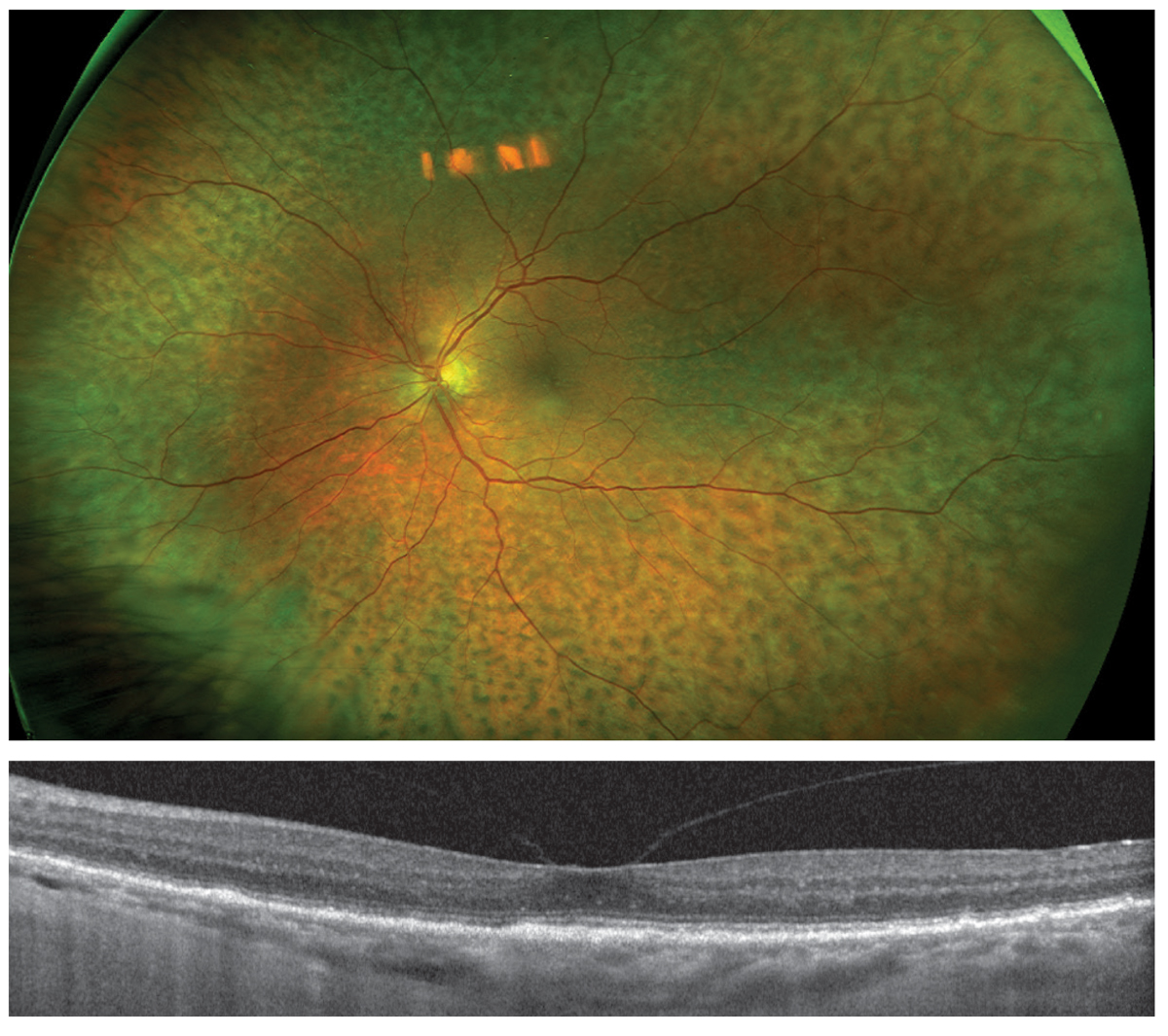 Fig. 19. One year post-op, fundus photography (top) shows persistent pigmentary change but complete resolution of choroidal and retinal detachments. OCT (bottom) shows resolution of subretinal fluid, normalized choroidal thickness and absence of choroidal folds.