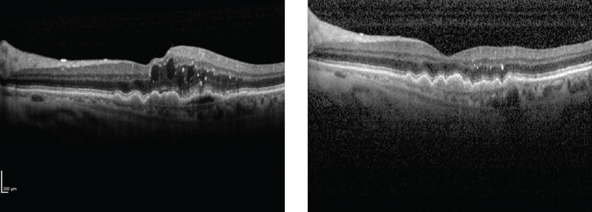 This study found that not every wet AMD patient needs multiple injections, as lack of continued therapy had no significant impact on outcomes. This photo shows a patient before and after treatment. Photo: Anat Loewenstein, MD.