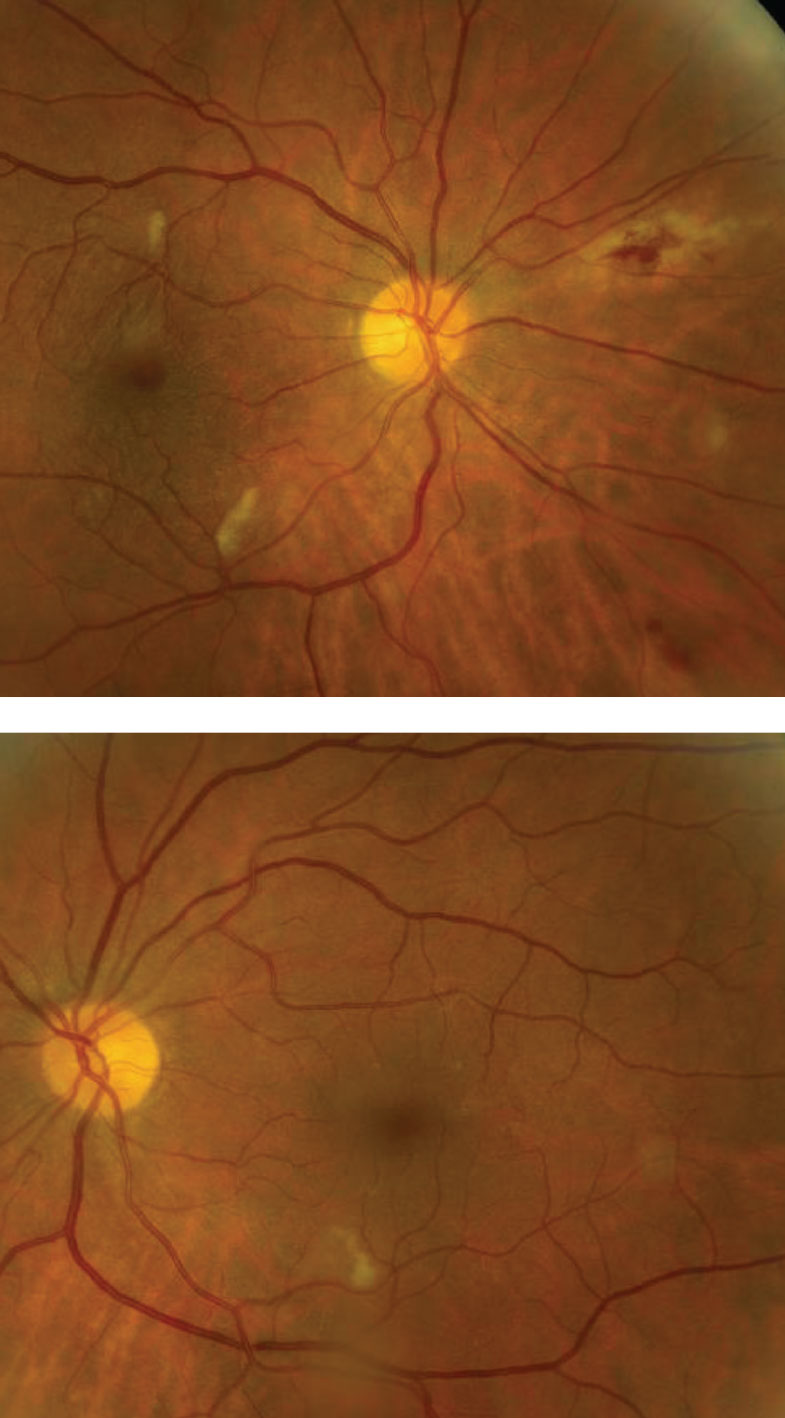 The cotton wool spots and other retinal findings observed in COVID-19 patients may actually be due to underlying conditions, research shows. Photo: Mark Dunbar, OD. 