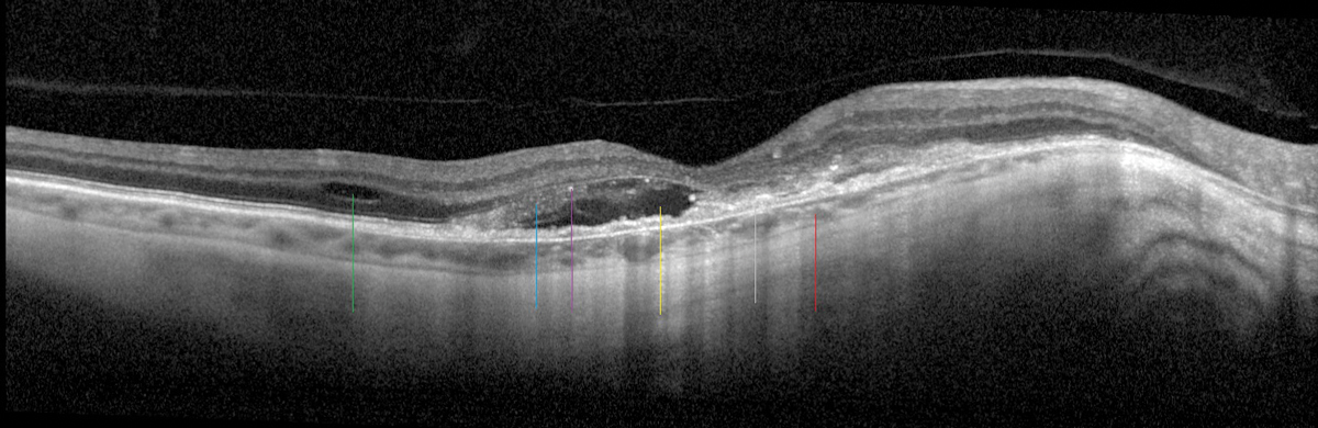 A highly myopic patient with a tessellated and thin choroid (red line), RPE disruption (gray line), SRF (yellow line), IRF (green line), edematous photoreceptors (blue line) with early tubulation and hyperreflective material (purple line) are all consistent with myopic CNV.