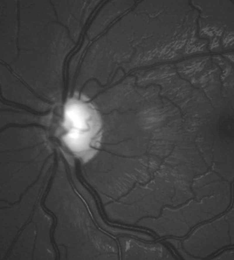 Glaucomatous optic disc of a 13-year-old with IOP of 43mm Hg. Photo: Joseph W. Sowka, OD. 