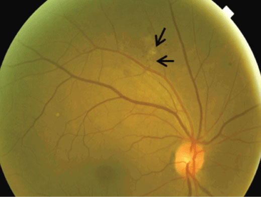 Retina micro-vasculopathy has been shown in this study to be more likely to present in patients with COVID-19. Photo: Gurpinderjeet Kaur, OD.