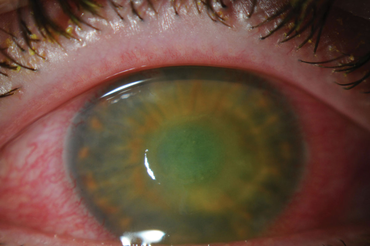 Learning models such as DeepKeratitis may eventually reduce the need for cornea specialist consultations and promote telehealth opportunities. Photo: Suzanne Sherman, OD.