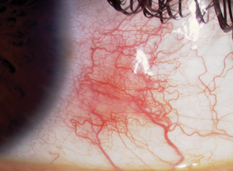 Anterior segment OCT-A may be useful to evaluate the initial changes in limbal vasculature in contact lens users.