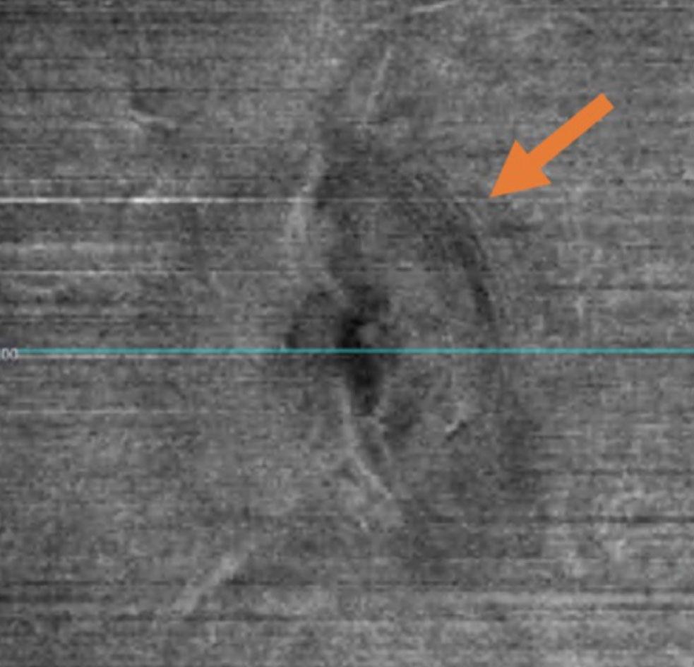 Fig. 4. Peripapillary wrinkles seen on en face VRI OCT imaging.