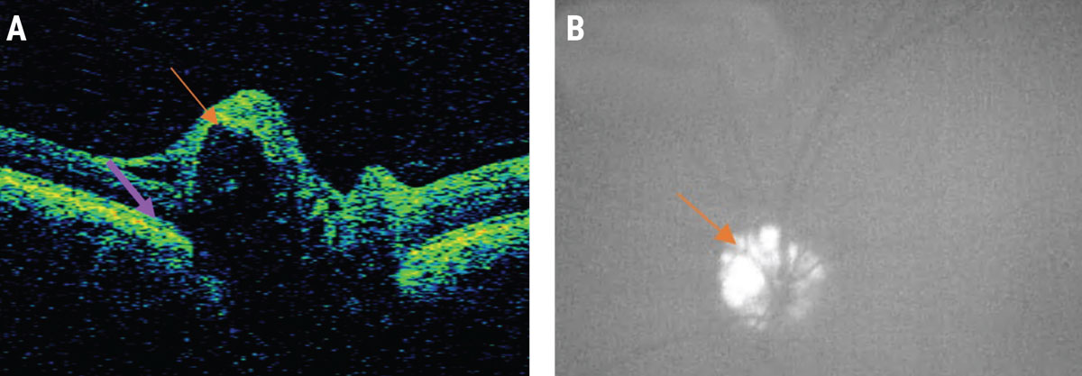 Fig. 5. A patient with pseudo-papilledema: (A) Note the ODD (orange arrow) in this OCT image, characterized by a signal poor lesion with a hyper-reflective cap. Also seen is the downward deflection of BM/RPE in a patient without papilledema denoted by the purple arrow. (B) Superficial ODD in the same patient seen as bright lesions on fundus autofluorescence. 