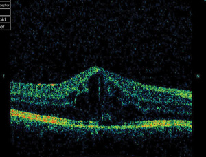 Adalimumab fared better than infliximab in this study for treatment of noninfectious uveitis.