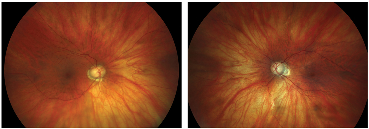 The likelihood of developing glaucoma skyrockets once myopic patients have a refractive error worse than -6D. Photo: Sarah B. Klein, OD. 