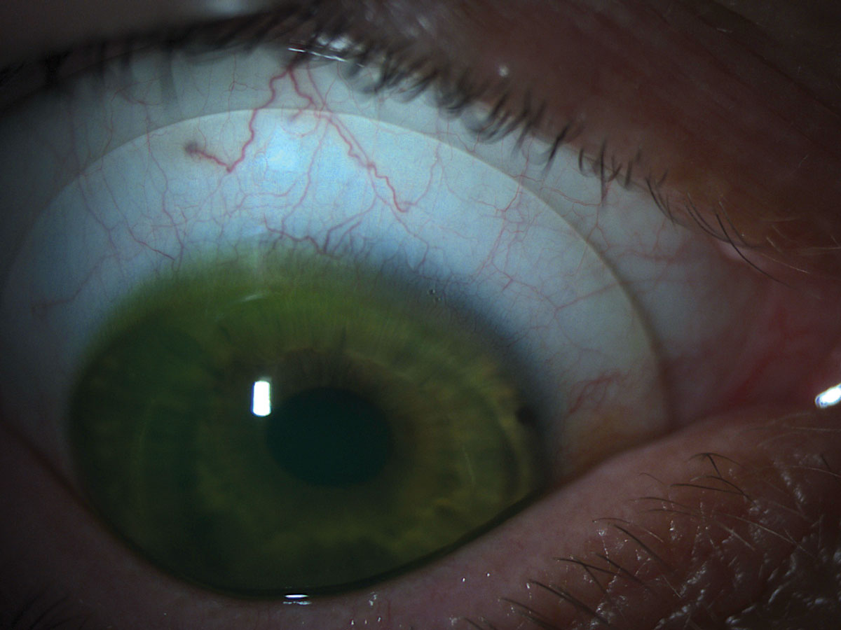 Scleral lenses are one of the many specialty items you can offer your patients.