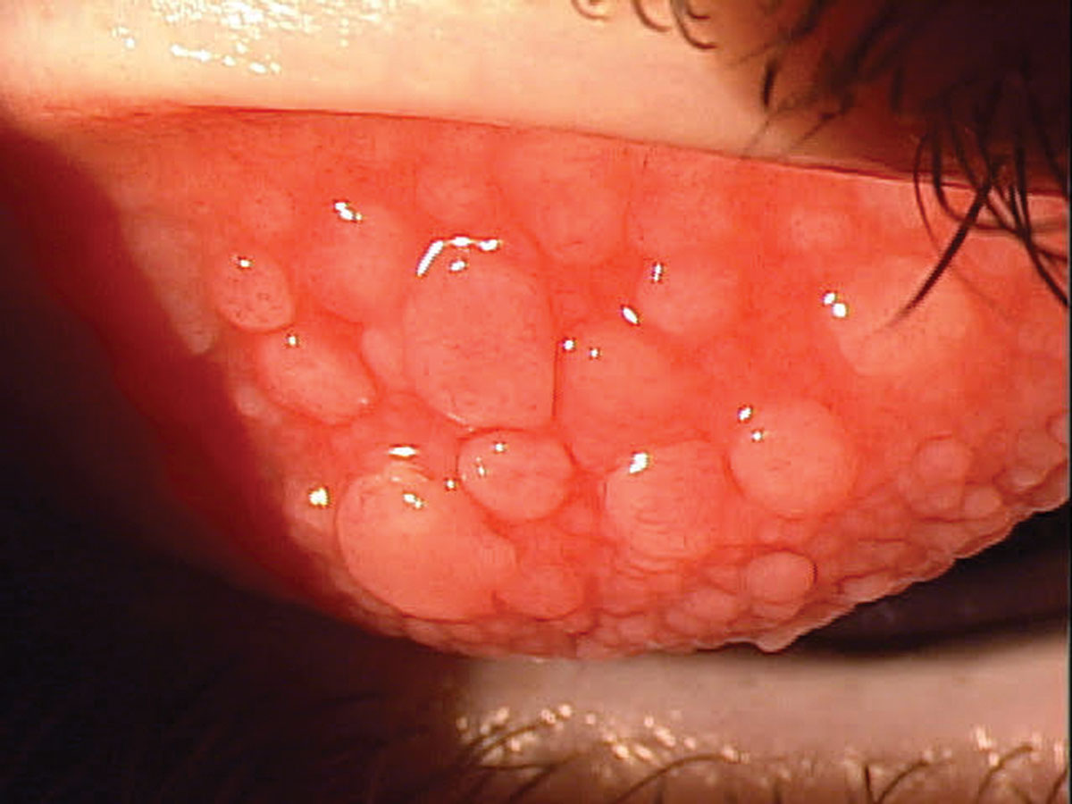 Vernal keratoconjunctivitis before treatment started. Management of this condition and long-term care is essential, as recurrence is a top concern.