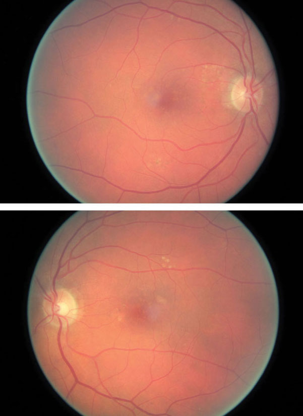 AMD patients are at an increased risk of submacular hemorrhages. Photo: Amanda Legge, OD. 