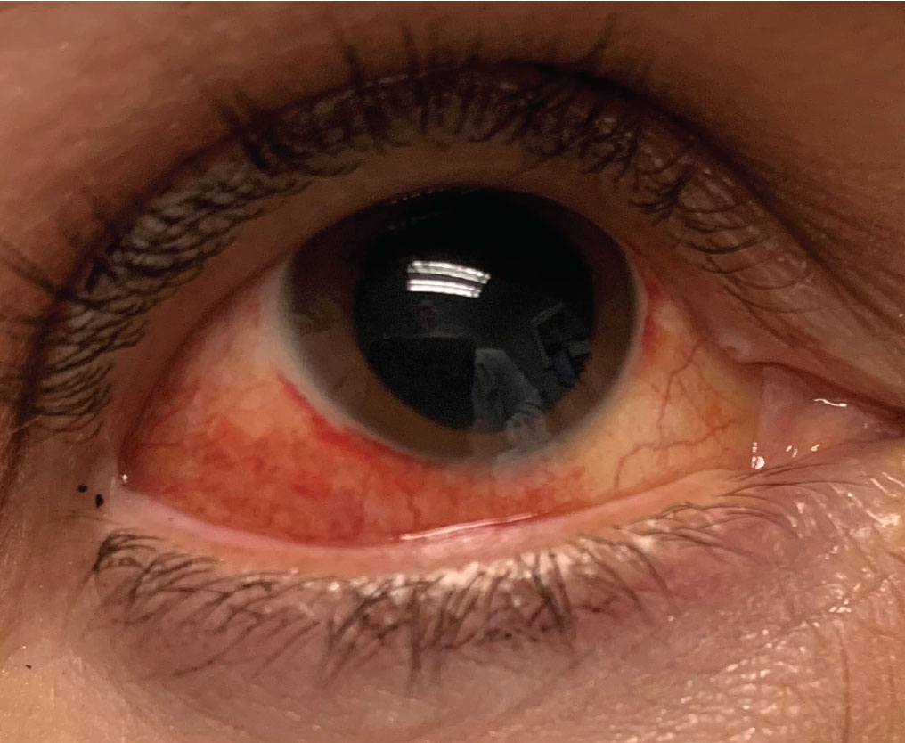 Sectoral injection in episcleritis.