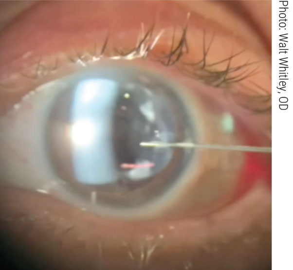 Durysta delivers bimatoprost into a patient’s anterior chamber.