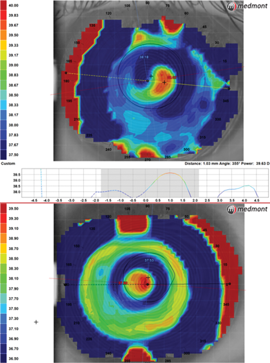 Topography measuring 1mm of temporal lens decentration in a center-near lens (top map) contrasted with a scleral multifocal using decentered optics to align the near zone with the visual axis (bottom).