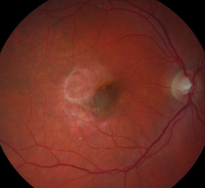 Cadaver study finds no evidence of accelerated AMD following cataract surgery. Photo: Jay M. Haynie, OD.