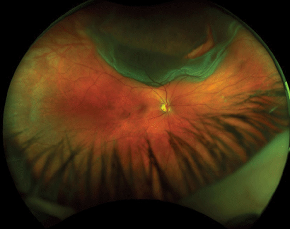 This study found retinal detachment to be more common in those living in deprivation. Photo: Richard Mangan, OD.