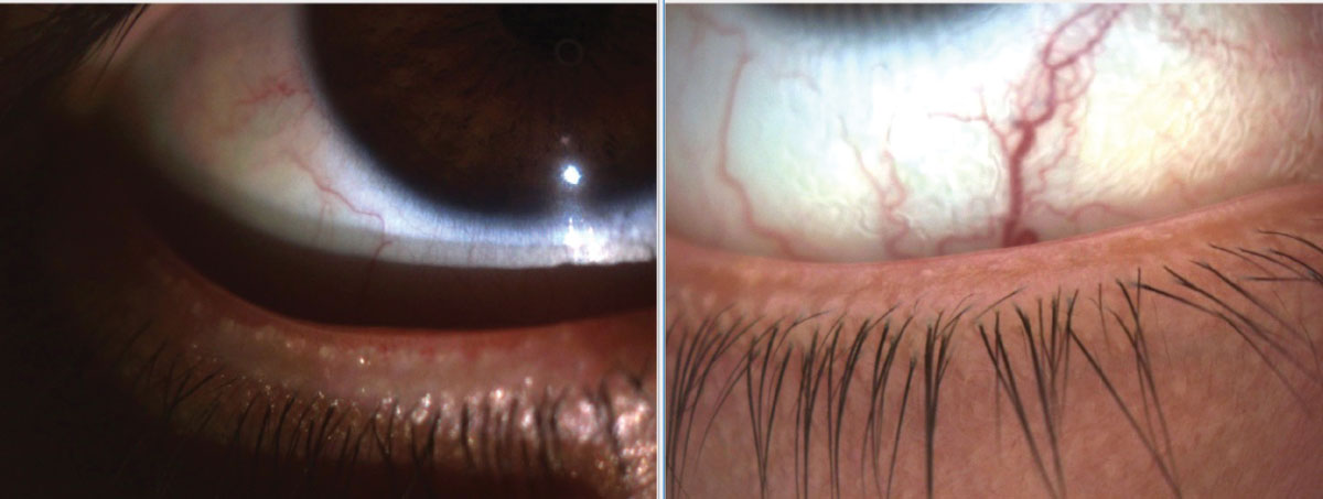 Lid margin integrity and meibum function improving due to office-based treatments in a 27-year-old female patient with DED secondary to MGD. She works in a healthcare facility and prolonged face mask wear has exacerbated her dry eye condition.