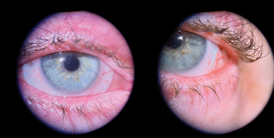Fig. 3. Advanced blepharitis with lid margin erythema, scarring and telangiectasia. Note areas of missing lashes and lashes clumping in a triangular fashion.