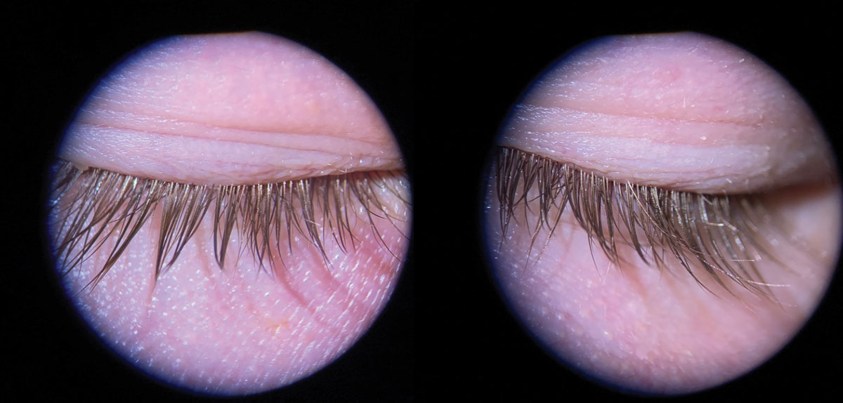 Fig. 8. Superior lid margins and lashes of the same younger male patient (Fig. 1) after comprehensive in-office lid cleaning.
