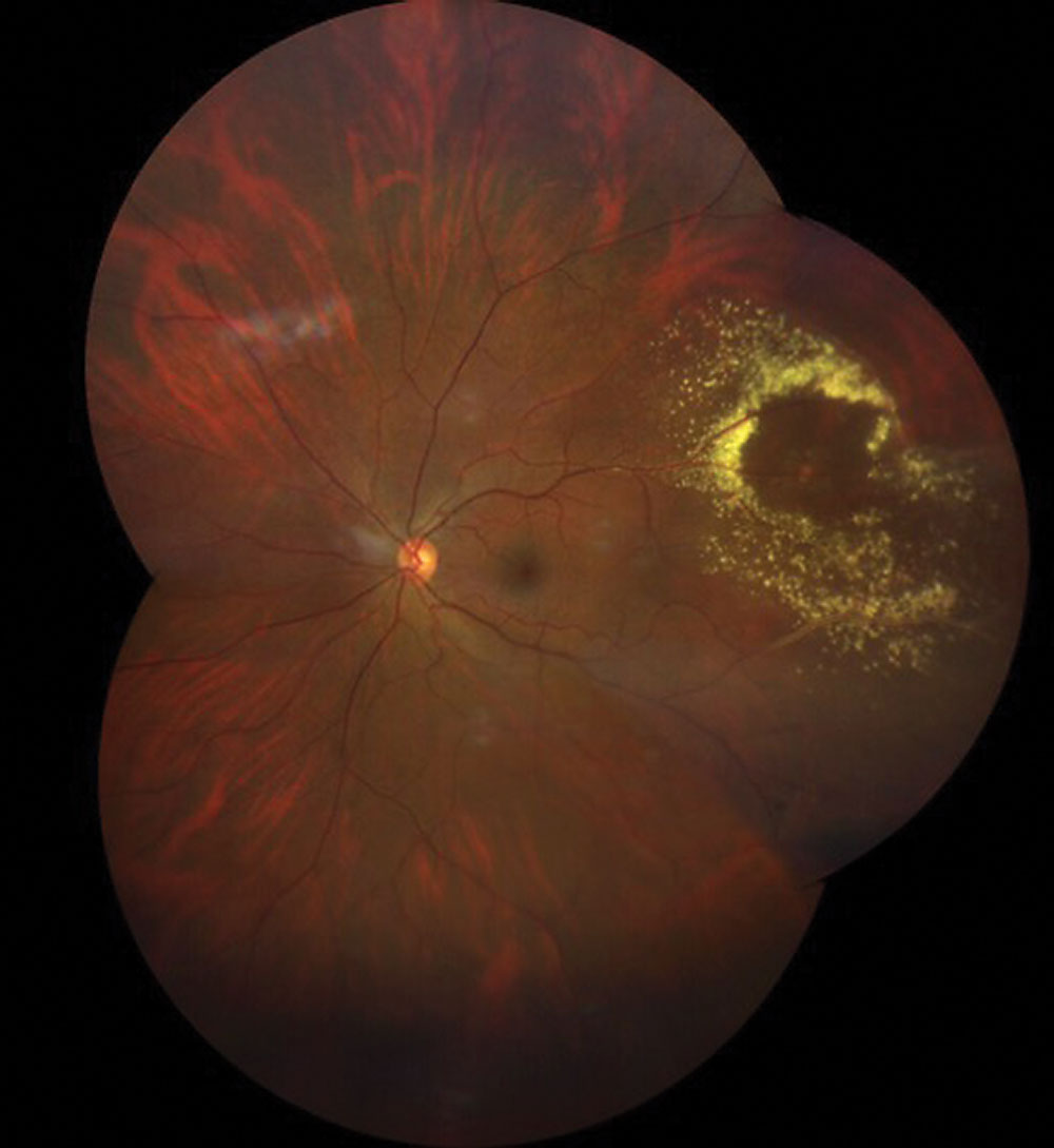 Fig. 1. A widfield fundus image of the retina in the patient. What is the diagnosis?