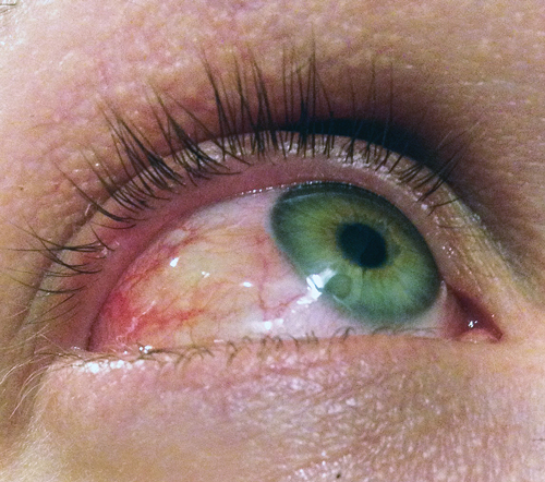 Social distancing and similar infection control measures have resulted in a lower incidence of conjunctivitis.