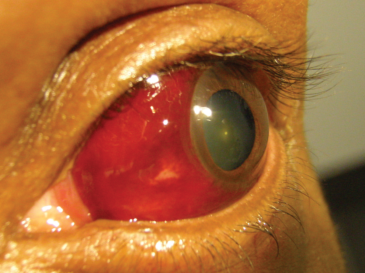 Subconjunctival hemorrhages were not linked to an increased risk of stroke in this study. Photo: Andrew S. Gurwood, OD. Click image to enlarge.