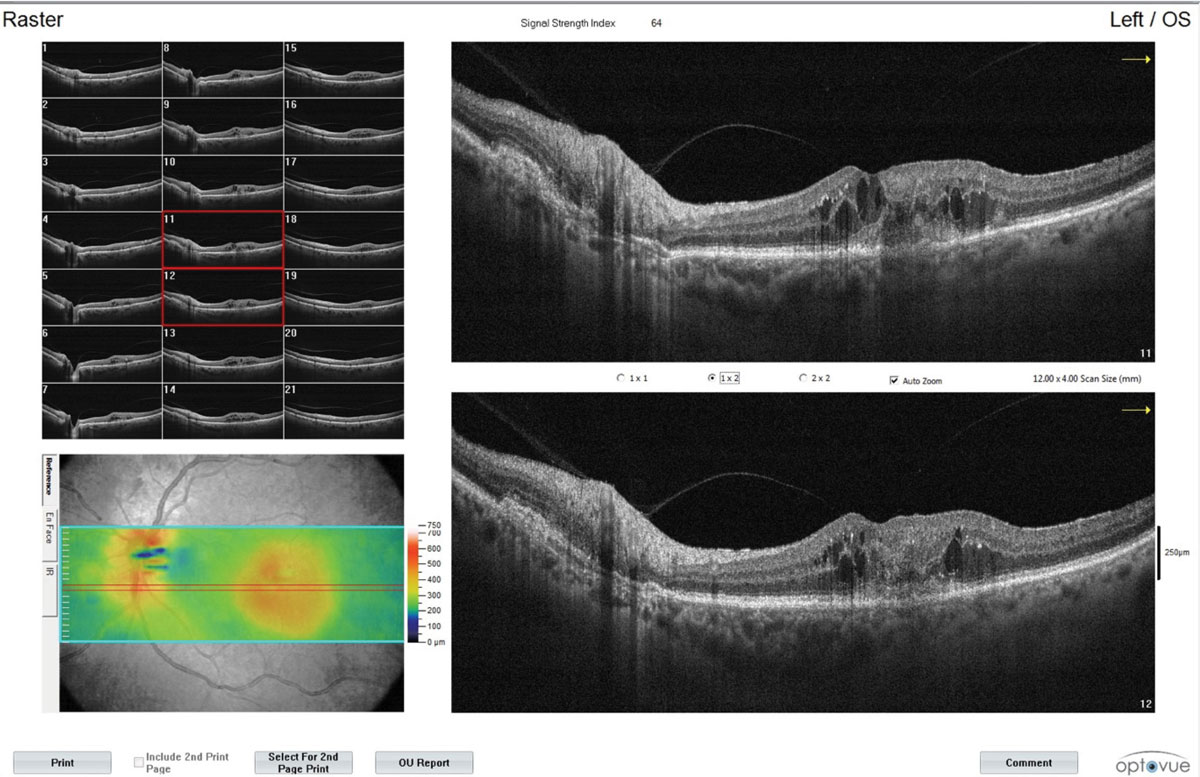 Retinal fluid decreases the effectiveness of anti-VEGF injections. Photo: Steven Ferrucci, OD, and Brenda Yeh, OD. 