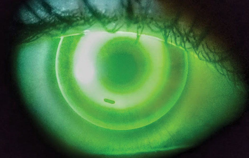 Ortho-K is a viable option for patients with myopia or other refractive error. Photo: Dan Fuller, OD.