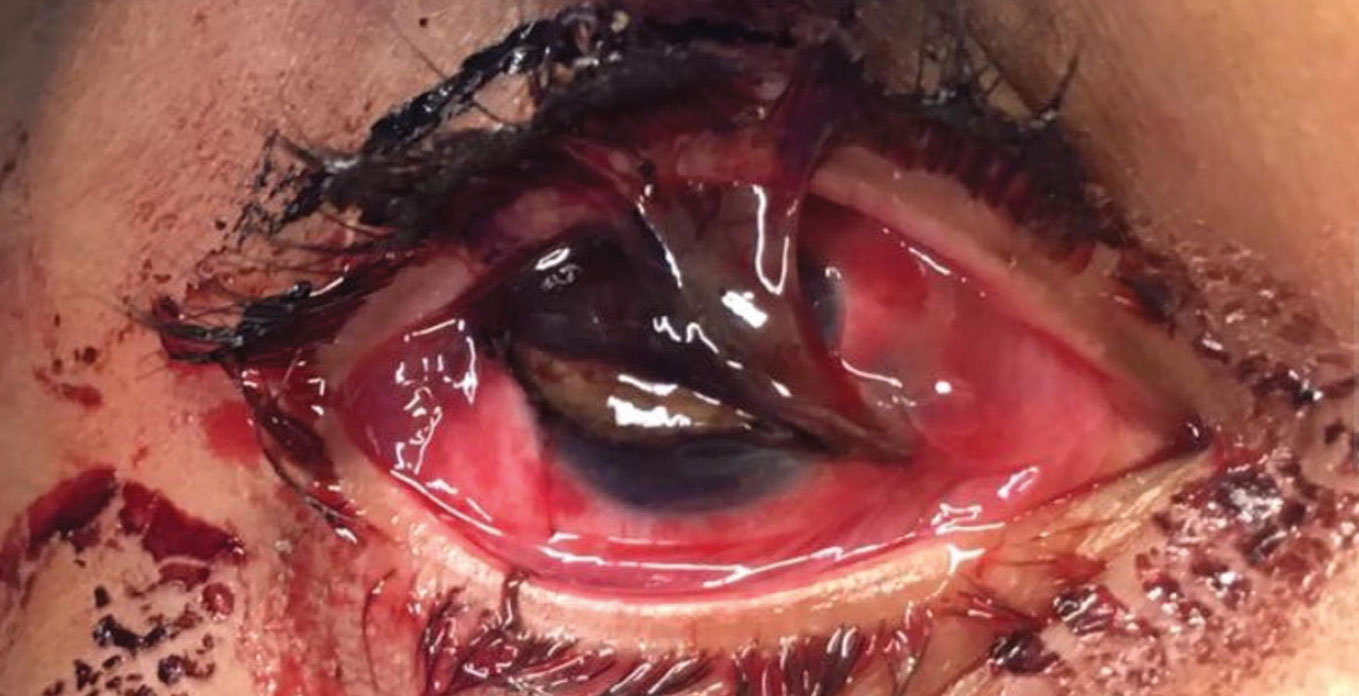 A full-thickness corneal laceration with iris prolapse in a patient with a similar injury to the case described here.