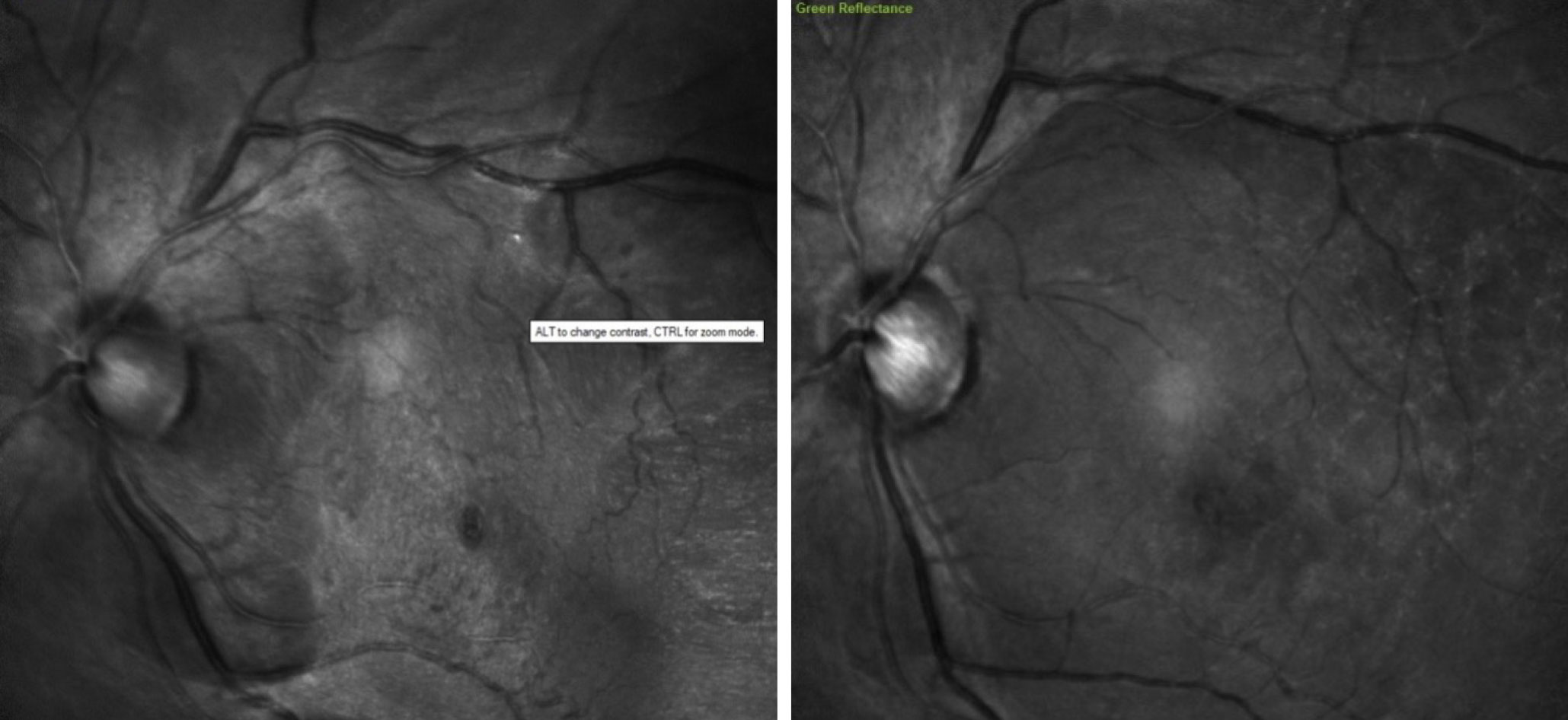 Note the initial central macular and foveal distortion (left). Here we see significant reduction in distortion post-vitrectomy (right).