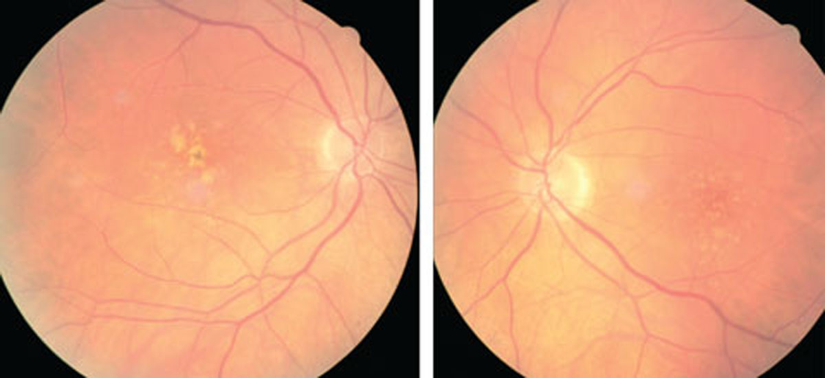 AMD eyes on anti-VEGF are less likely to show a correlation between CST and BCVA. Photo: Julie Poteet, OD. 