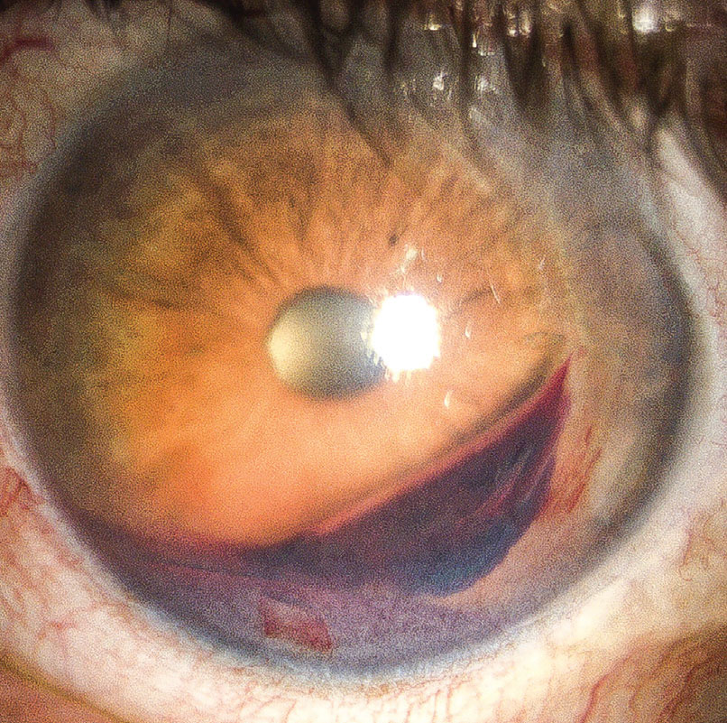 If hyphema is mild, increasing the steroid dosage may help it clear faster.