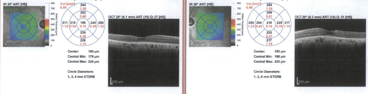 SD-OCT of the patient’s initial visit showing loss of the IS-OS junction and outer nuclear layer.
