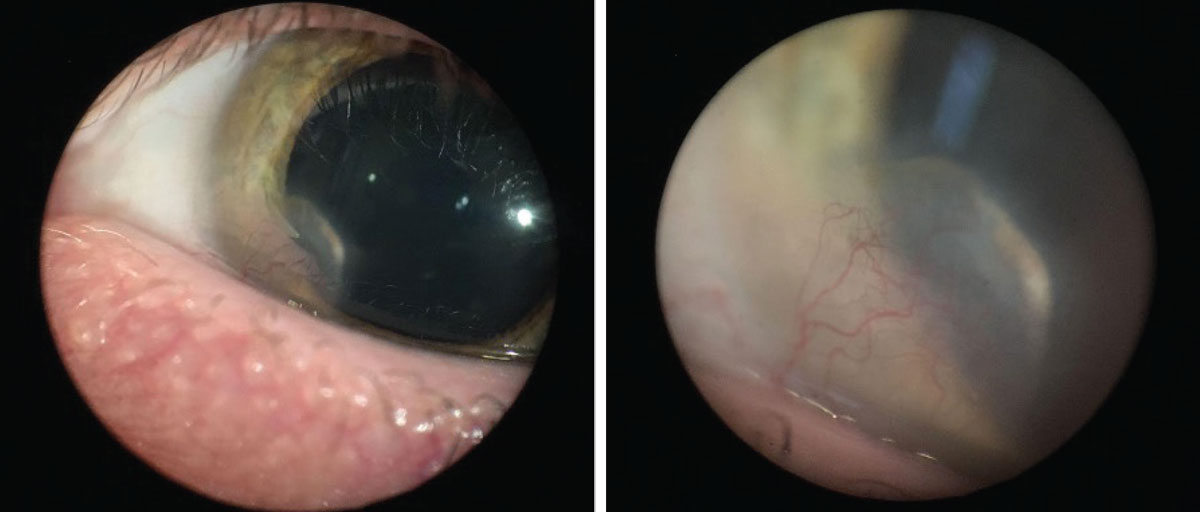 Fat deposits with adjacent abnormal vascularization in the cornea are characteristic of LK. 