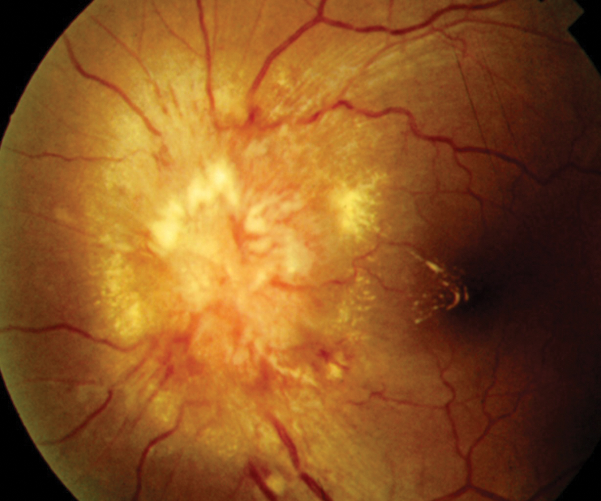 Neuroretinitis from cat scratch disease is typically a self-limiting condition with an excellent prognosis.
