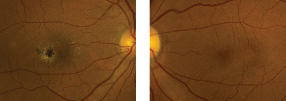 Together, microperimetry and multifocal electroretinography can be used as tools to accurately assess the macula. Photo: Eric Dillinger, OD. 