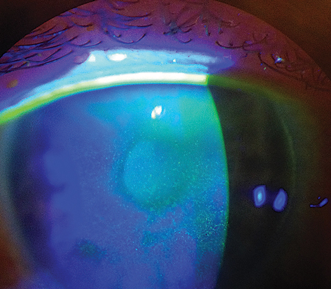 Dry eye disease is more prevalent among people of certain ethnicities, study shows. Photo: Scott G. Hauswirth, OD. 