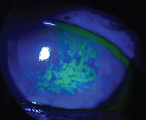 Sjögren’s patients with dry eye may benefit from treatment with cyclosporine A. Photo: Vin Dang, OD. 