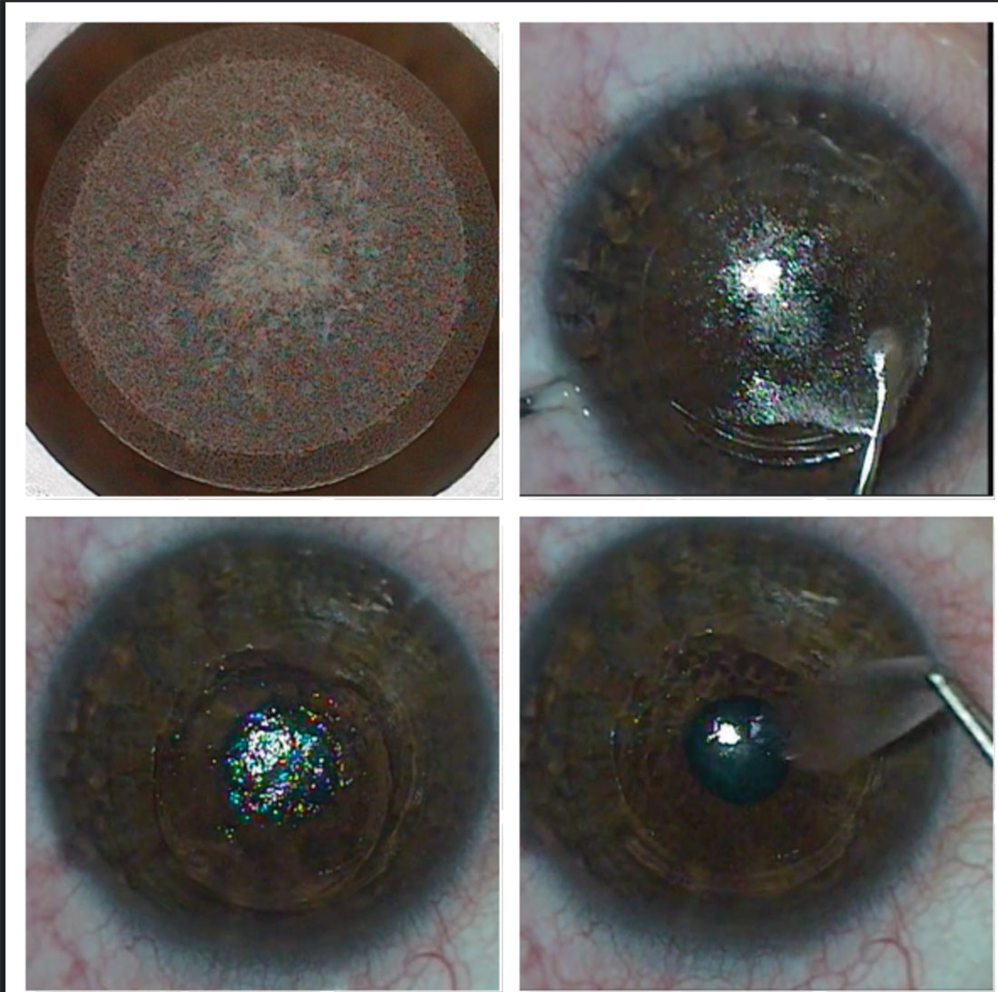 Fig. 4. The SMILE procedure creates (top left), dissects (top right) and removes a lenticule (bottom left and right) to correct myopia and myopic astigmatism.